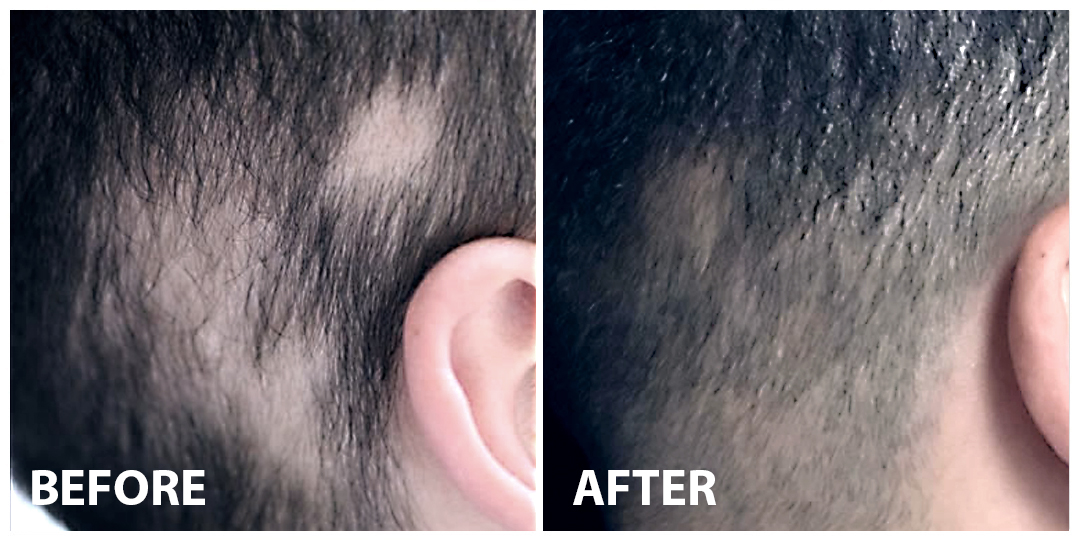 HAIR GROWTH LASER Before After
