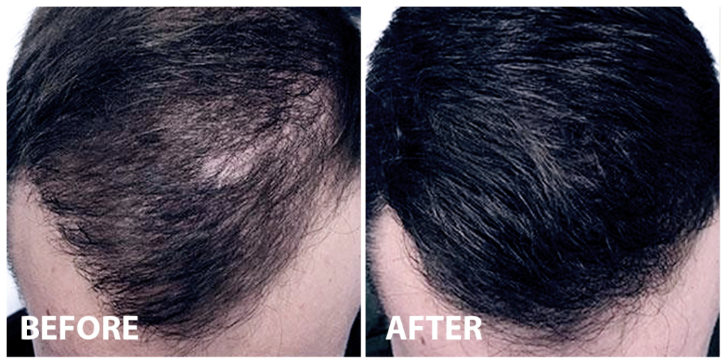 Hair Loss Clinic Services For Men Hair Specialists And Doctors In Malaysia