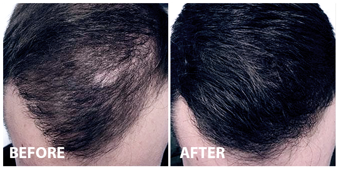 Hair Mesotherapy Before After