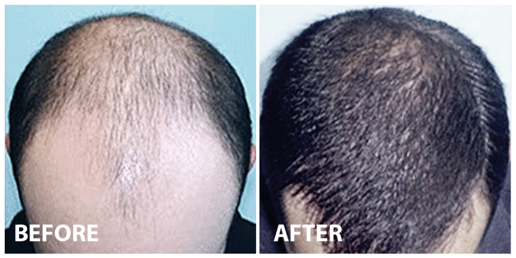 Stem Cell Hair Treatment And Transplant In Malaysia Regrow Hair Premier Clinic 9259