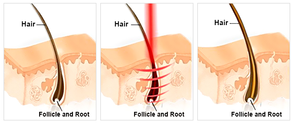 How does hair mesotherapy work?