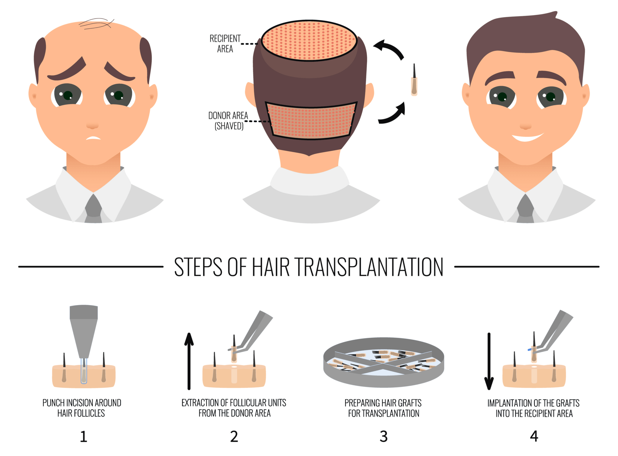 FUE Hair Transplant 