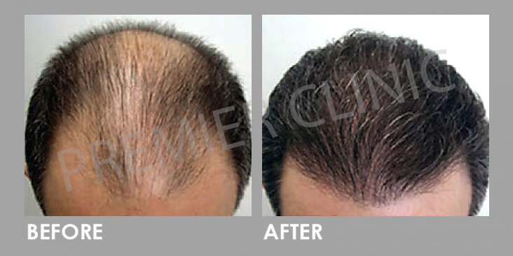 FUE Hair Transplant - Before & After 01