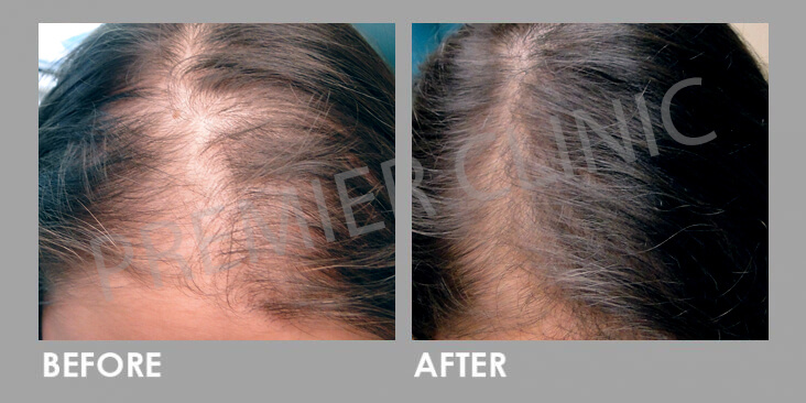 FUE Hair Transplant - Before & After 02