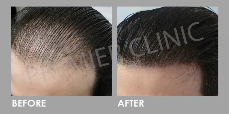 FUE Hair Transplant - Before & After 03