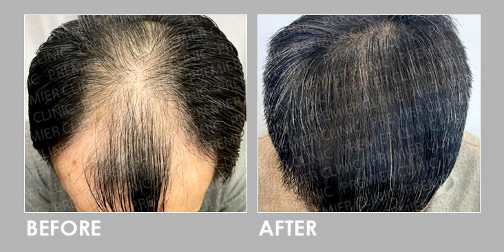 FUE Hair Transplant Before After
