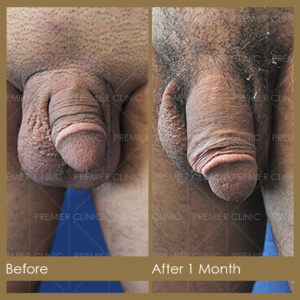 Premier Penis Enlargement Filler Before & After