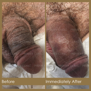 Premier Penis Enlargement Filler Before & After