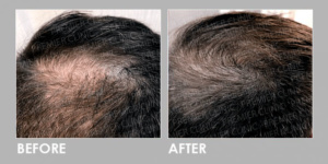 BEFORE & AFTER EXOSOME HAIR LOSS THERAPY