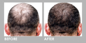 BEFORE & AFTER EXOSOME HAIR LOSS THERAPY