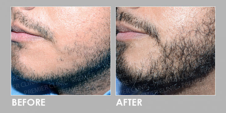 FUE Beard Hair Transplant | Premier4Him