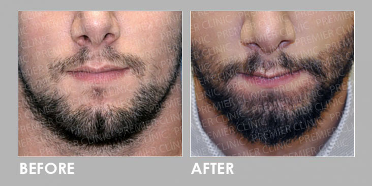 FUE Beard Hair Transplant | Premier4Him