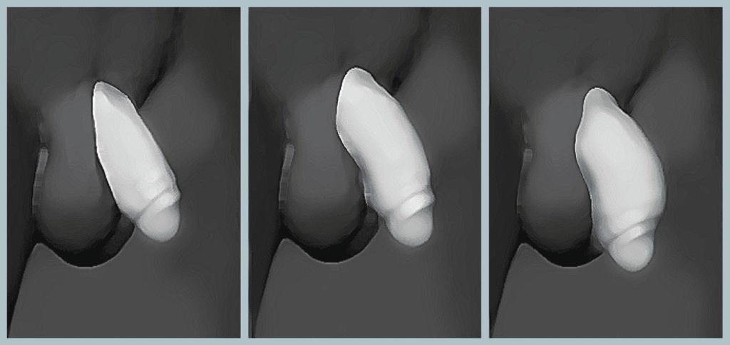 Penis Enlargement in pemier clinic kl