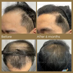 Premier FUE Before & After