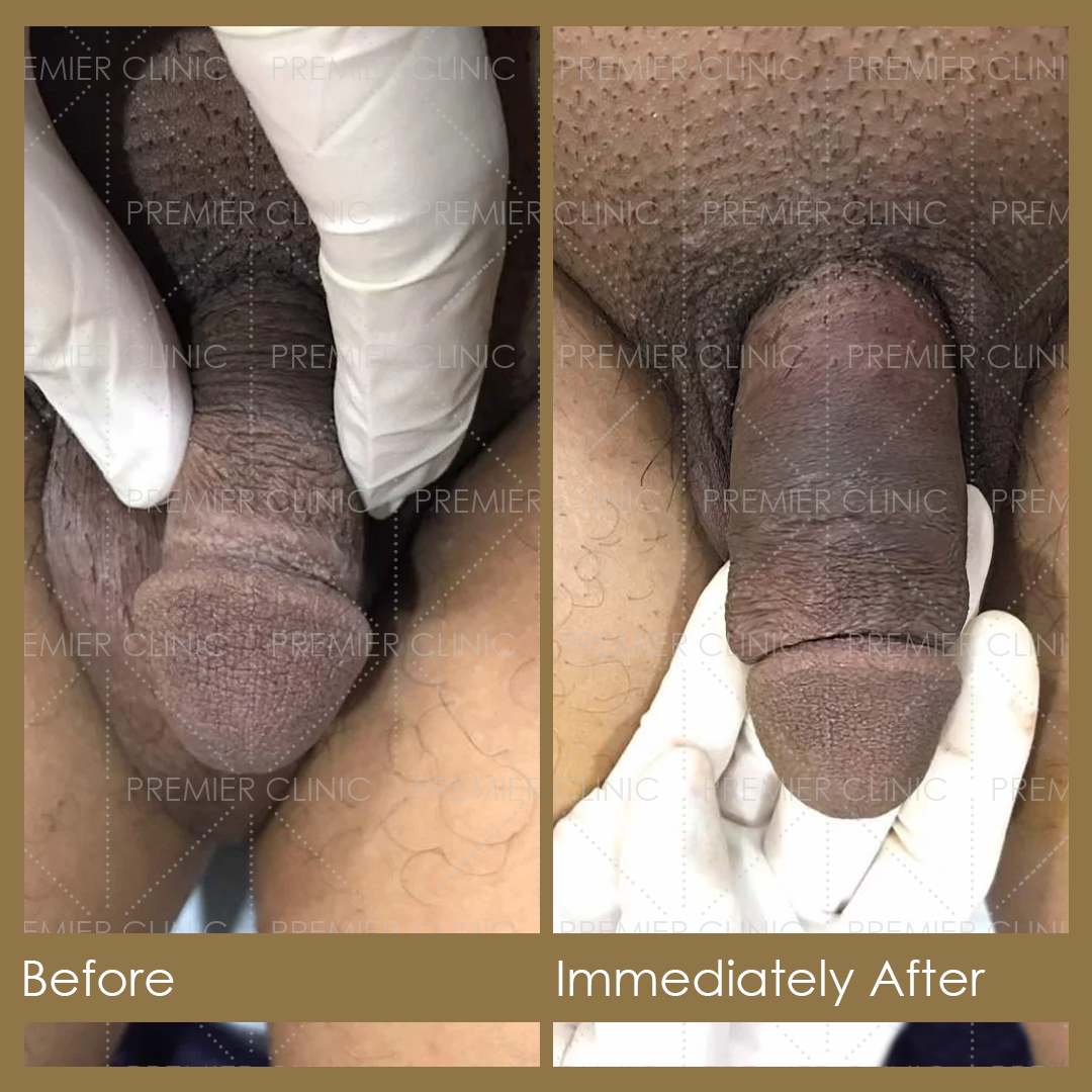 Premier Penis Enlargement Filler Before & After