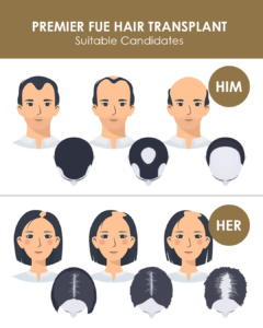 Suitable Candidates for FUE hair transplant