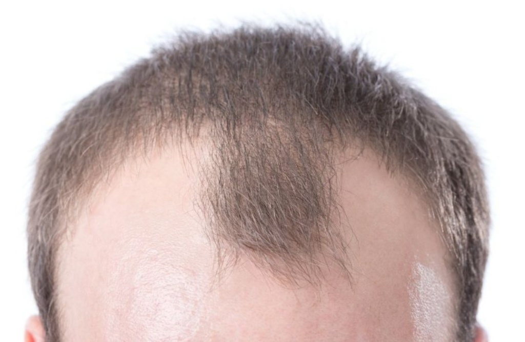 hair loss clinic receding hairline