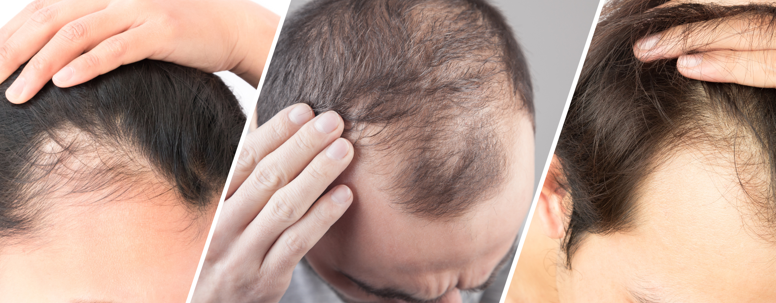 laser treatment for hair growth