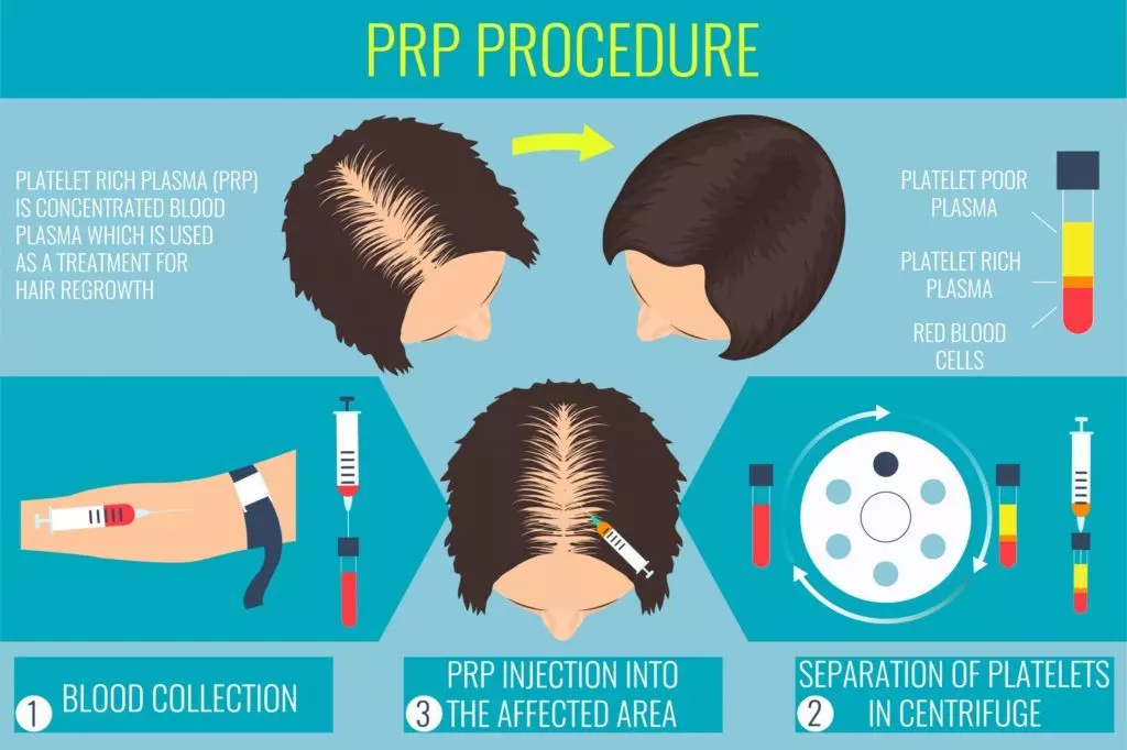 prp hair infographic